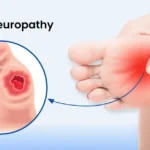 Diabetic Neuropathy