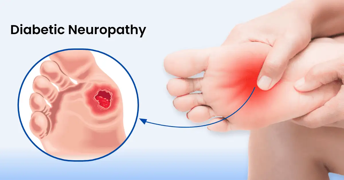 Diabetic Neuropathy