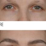 Eyebrow Transplant in London: Affordable Prices and Amazing Transformations