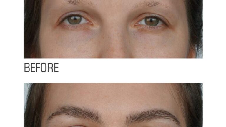 Eyebrow Transplant in London: Affordable Prices and Amazing Transformations