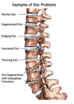 degenerative disc disease