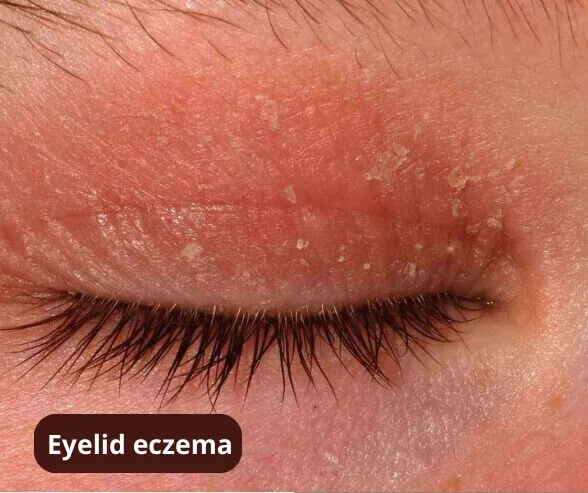 dermatitis around the eyes