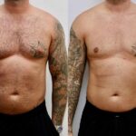 gynecomastia surgery uae