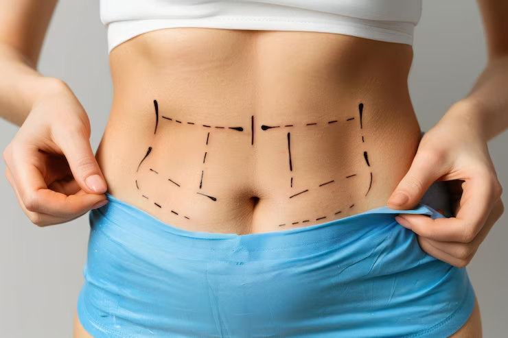 image-125 Achieve Your Dream Shape: Tailored Body Contouring in Houston