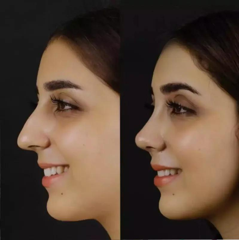 Restore Function and Form with Nose Deviated Septum Surgery in Dubai