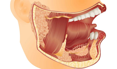 Submandibular gland surgery