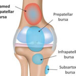 suprapatellar-bursitis-knee