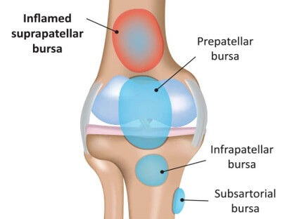 suprapatellar-bursitis-knee