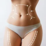 Why the Best Liposuction Surgeon in Dubai is Worth the Investment