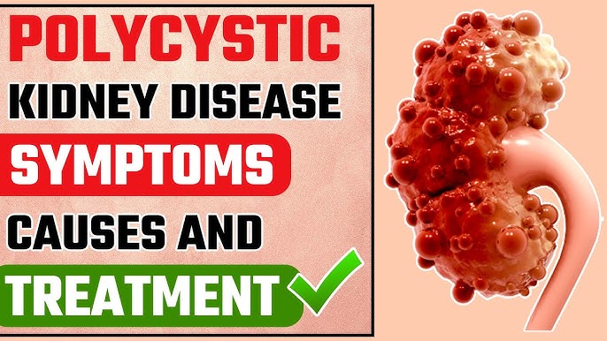 Adult Polycystic Kidney Disease Treatment