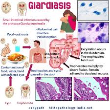 Giardiasis