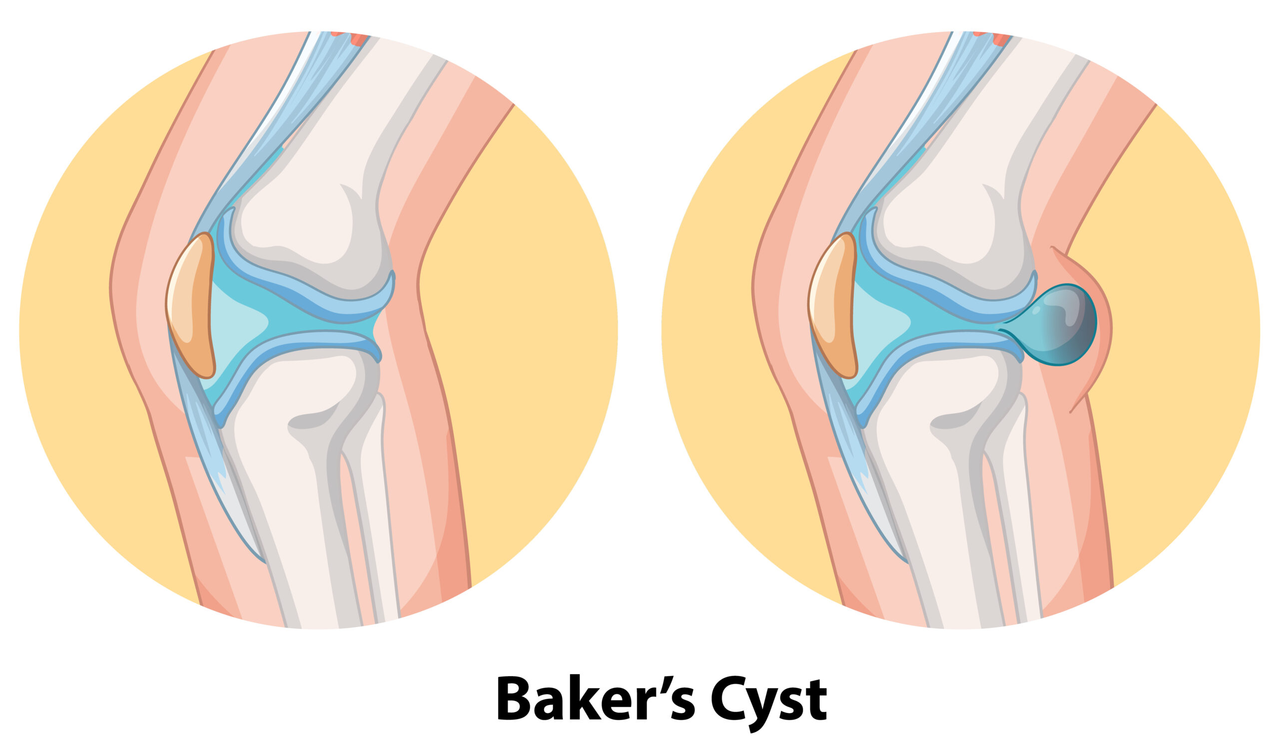 Knee Replacement Treatment In India