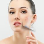 Effective Acne Treatment Using Laser Technology