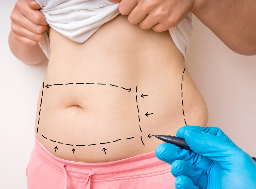 Achieving a Flatter Abdomen, What to Know Before Getting a Tummy Tuck