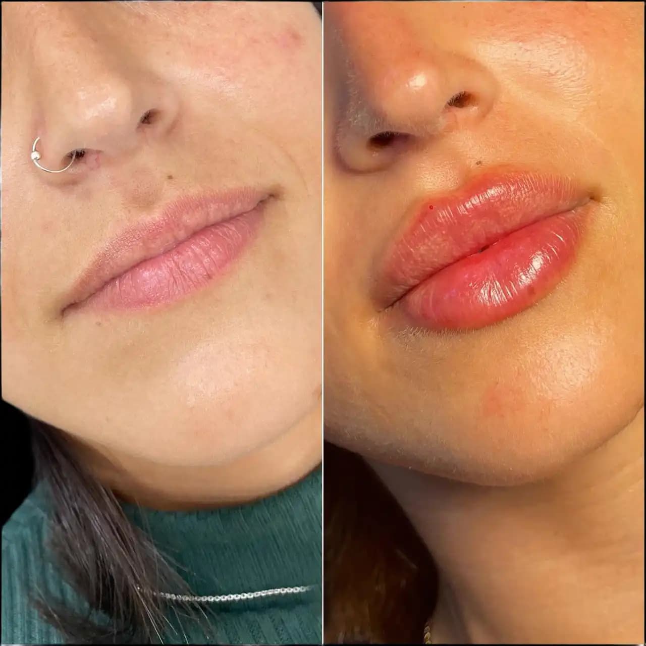 Lip Fillers Treatment in Dubai