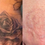 Tattoo Removal in Gwalior