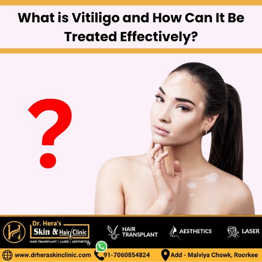 vitiligo effective treatment