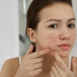 Acne Scar Treatment in Islamabad