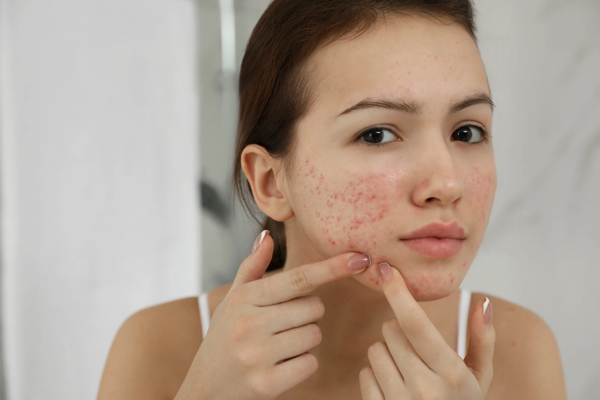 Acne Scar Treatment in Islamabad