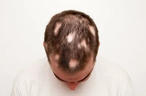 Alopecia Areata treatment