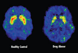 How Drugs Affect the Brain: The Neuroscience of Addiction