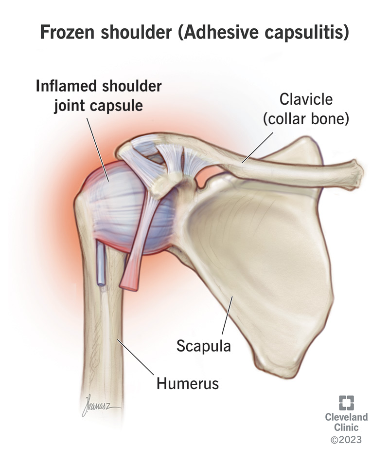 Frozen Shoulder