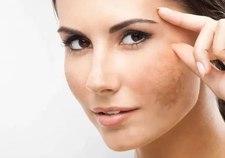 Dermal Pigmentation Treatments