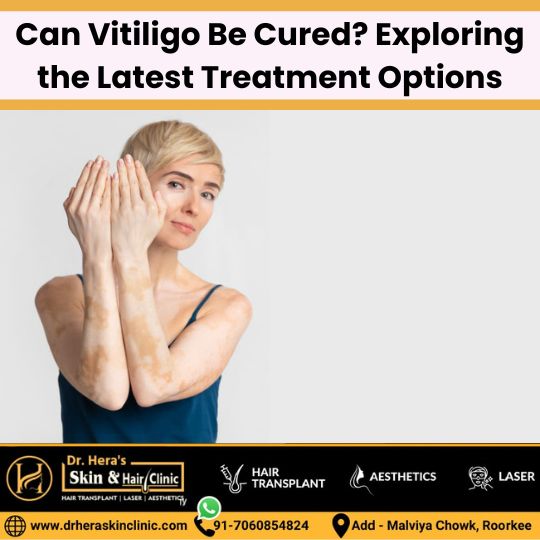 can vitiligo be cured