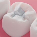 tooth cavity treatment