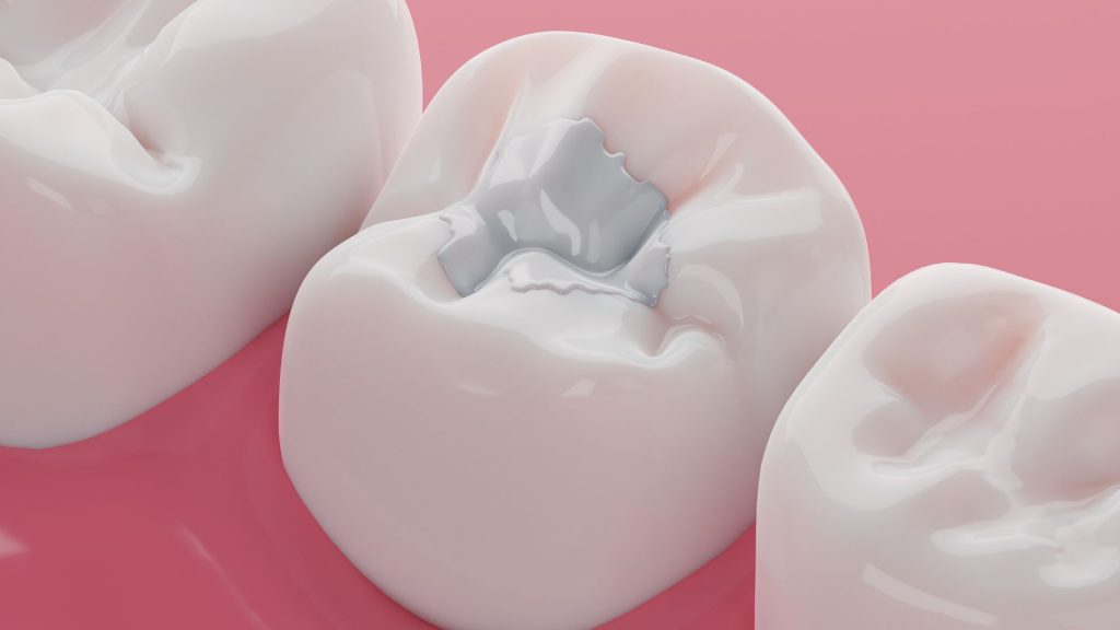 tooth cavity treatment