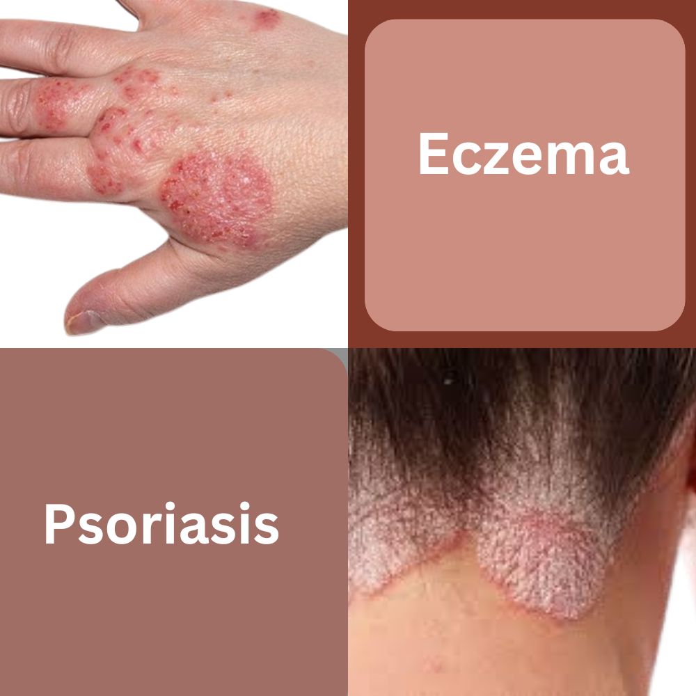 Psoriasis vs. Eczema