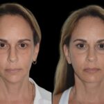 Chin Fillers treatments in dubai