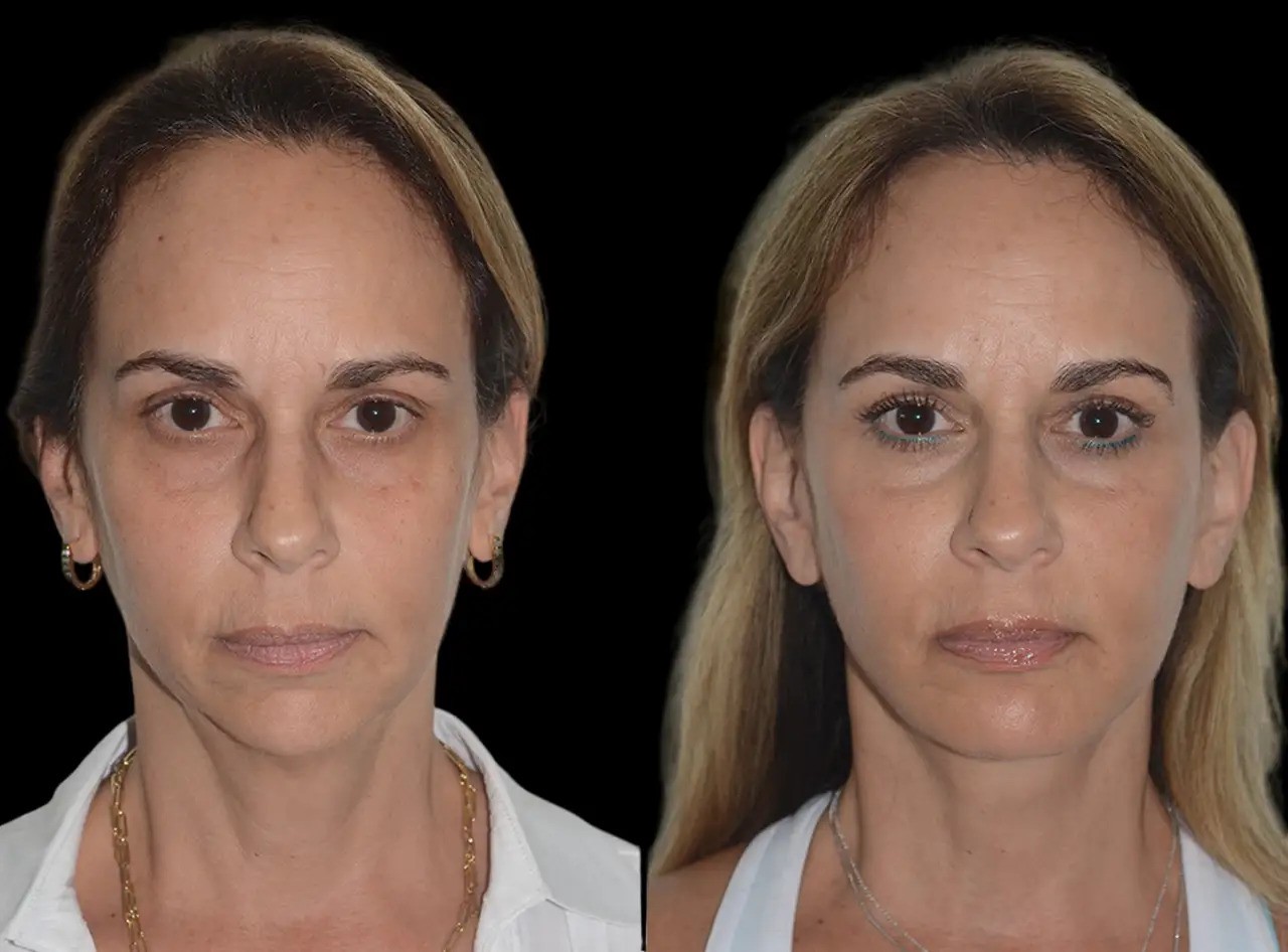 Chin Fillers treatments in dubai