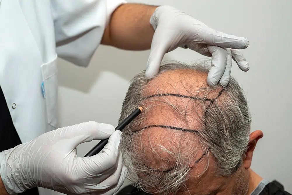 كم تكلفة عملية زراعة الشعر في دبي؟