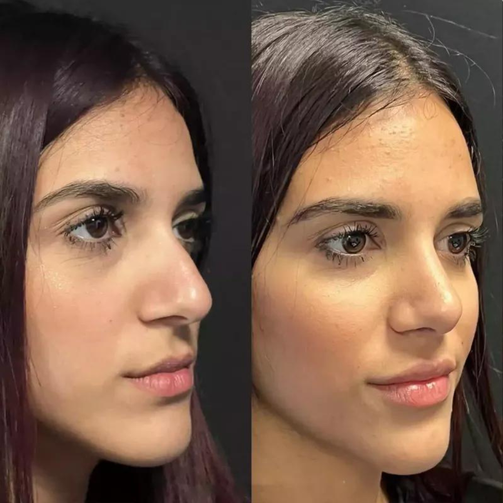 Why Choose Rhinoplasty in Dubai? Top Benefits and Results