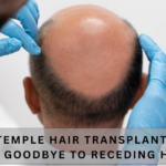 Temple Hair Transplant