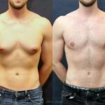 Best Gynecomastia surgeon in Dubai