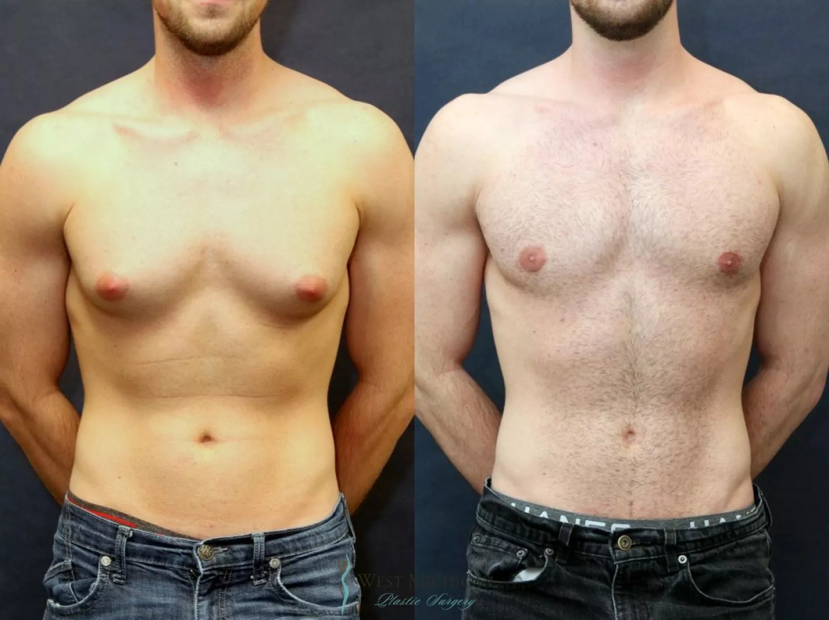 Best Gynecomastia surgeon in Dubai