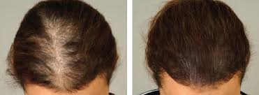 scalp micropigmentation for women