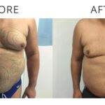 liposuction