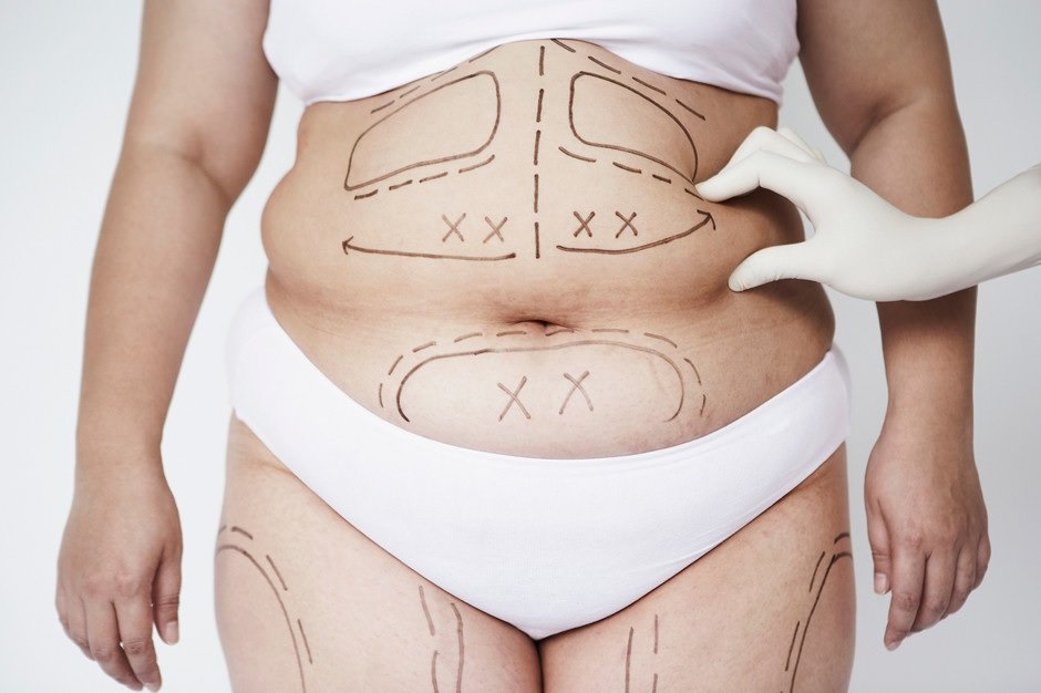 liposuction in Islamabad