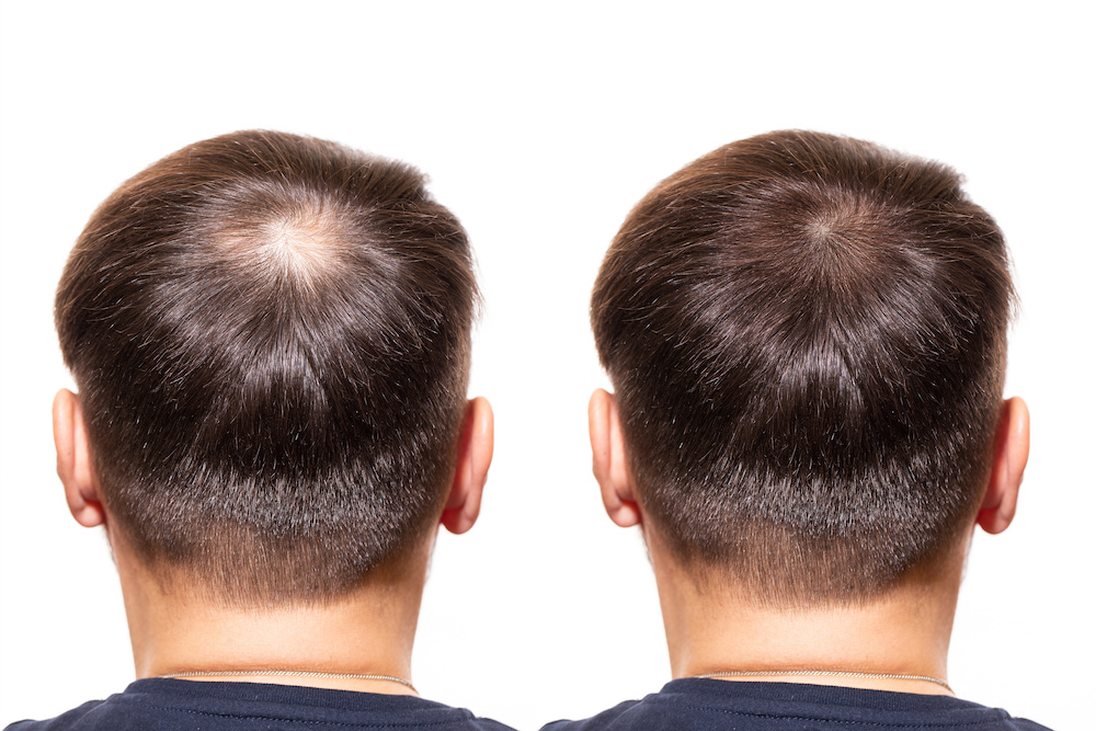 How Does Platelet-Rich Plasma Therapy Compare to Other Hair Loss Treatments?