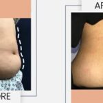 Liposuction in Lahore