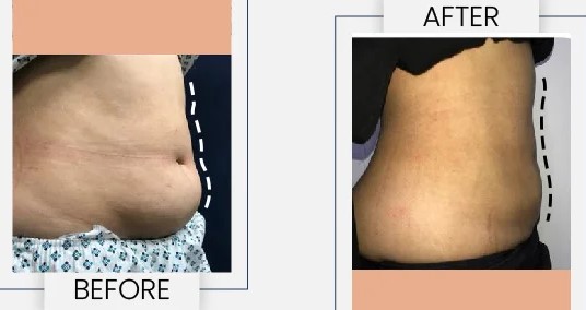 Liposuction in Lahore