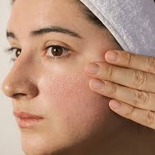 larg pores treatment in islamabad