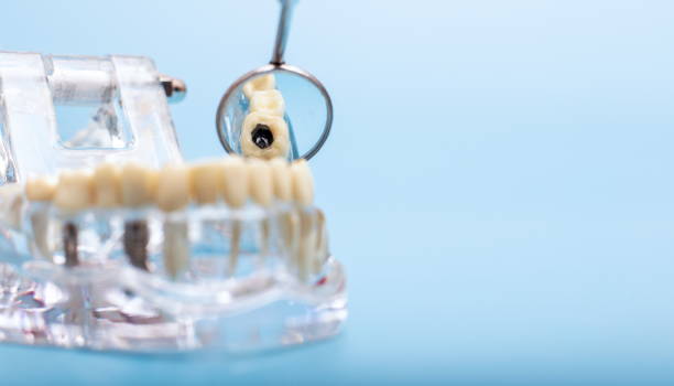 Dental-Implants