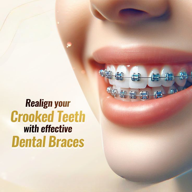 Dental braces in islamabad.