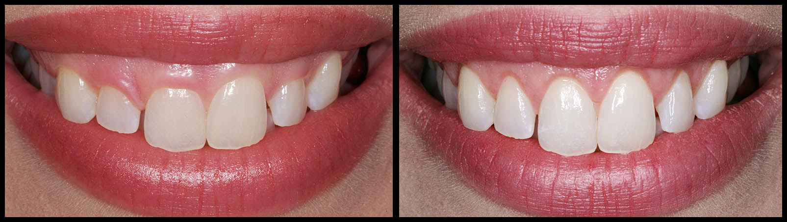 Gum Lifts in Houston