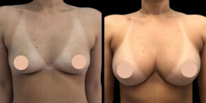 Breast Augmentation in Dubai