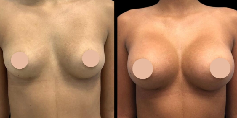 Dubai's Best Breast Augmentation Surgeons | Perfect Doctor